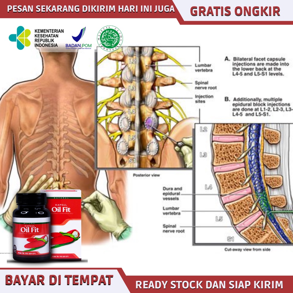 Obat saraf kejepit, obat saraf kejepit di kaki, obat saraf kejepit paha, betis, pinggang, obat herba