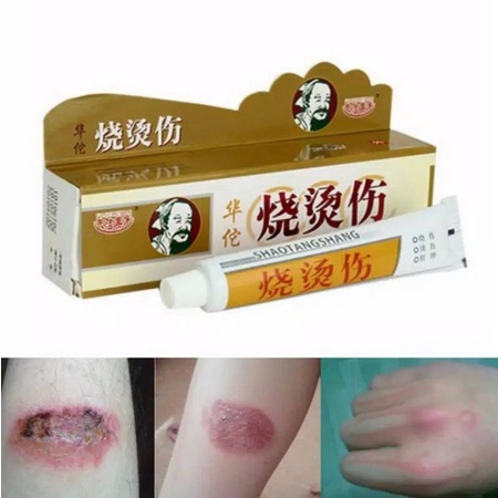 Obat Luka Bakar melepuh salep Huatuo 100% original Herbal tradisional cina shao tang shang keloid