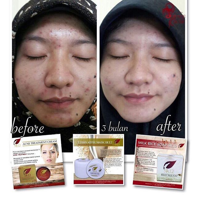 SR12 ACNE TREATMENT CREAM KRIM JERAWAT MERADANG &amp; MEMBANDEL AMPUH HILANGKAN JERAWAT