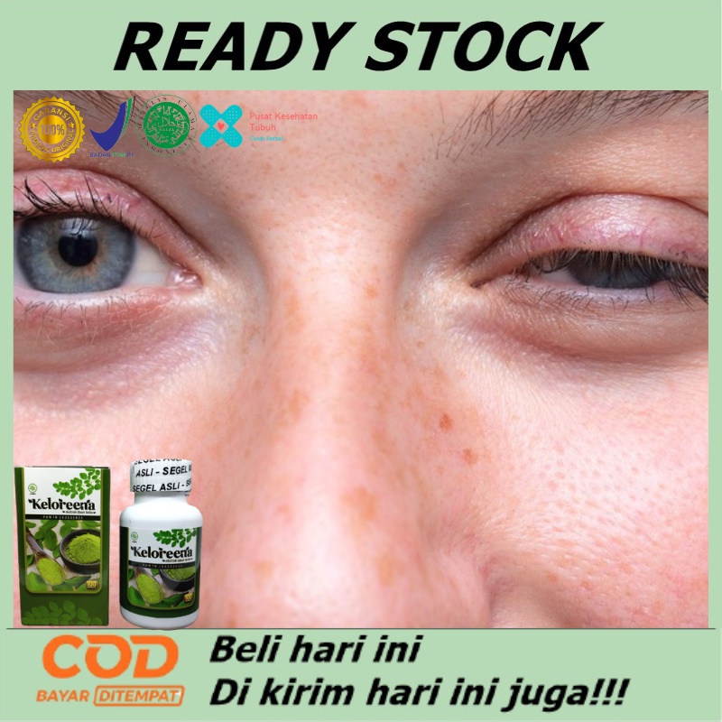 Obat Herbal Mata Ptosis, Obat Alami Mata Ptosis, Obat Kelopak Mata Turun Sebelah, Obat Mata Beda Seb