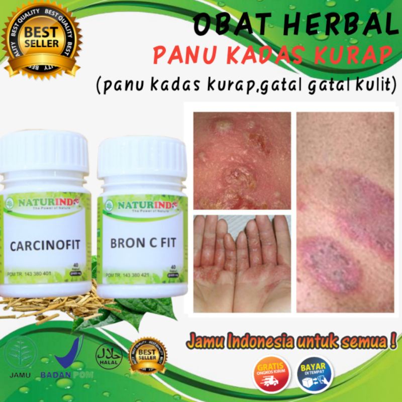 Obat Panu Paling Ampuh 100% Obat Kurap Kudis Paling Ampuh Obat Jamur Gatal Kulit Eksim Herbal Bron C
