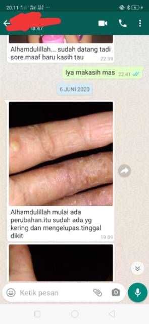 Salep BL Ampuh ASLI Original 100% | Obat Gatal | Salep Kulit Gatal | Obat Eksim Exim