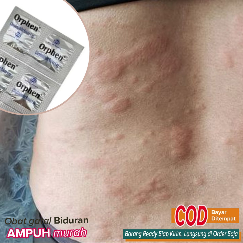 Obat Biduran AMPUH murah - orphen tab