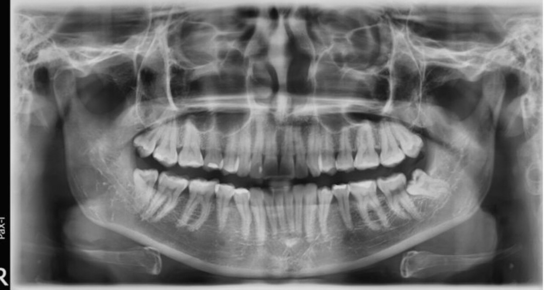 1 Buah Dental Chip Blower / Push Push