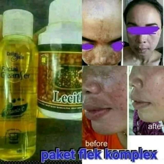 Paket Flek hitam mengatasi flek hitam membandel