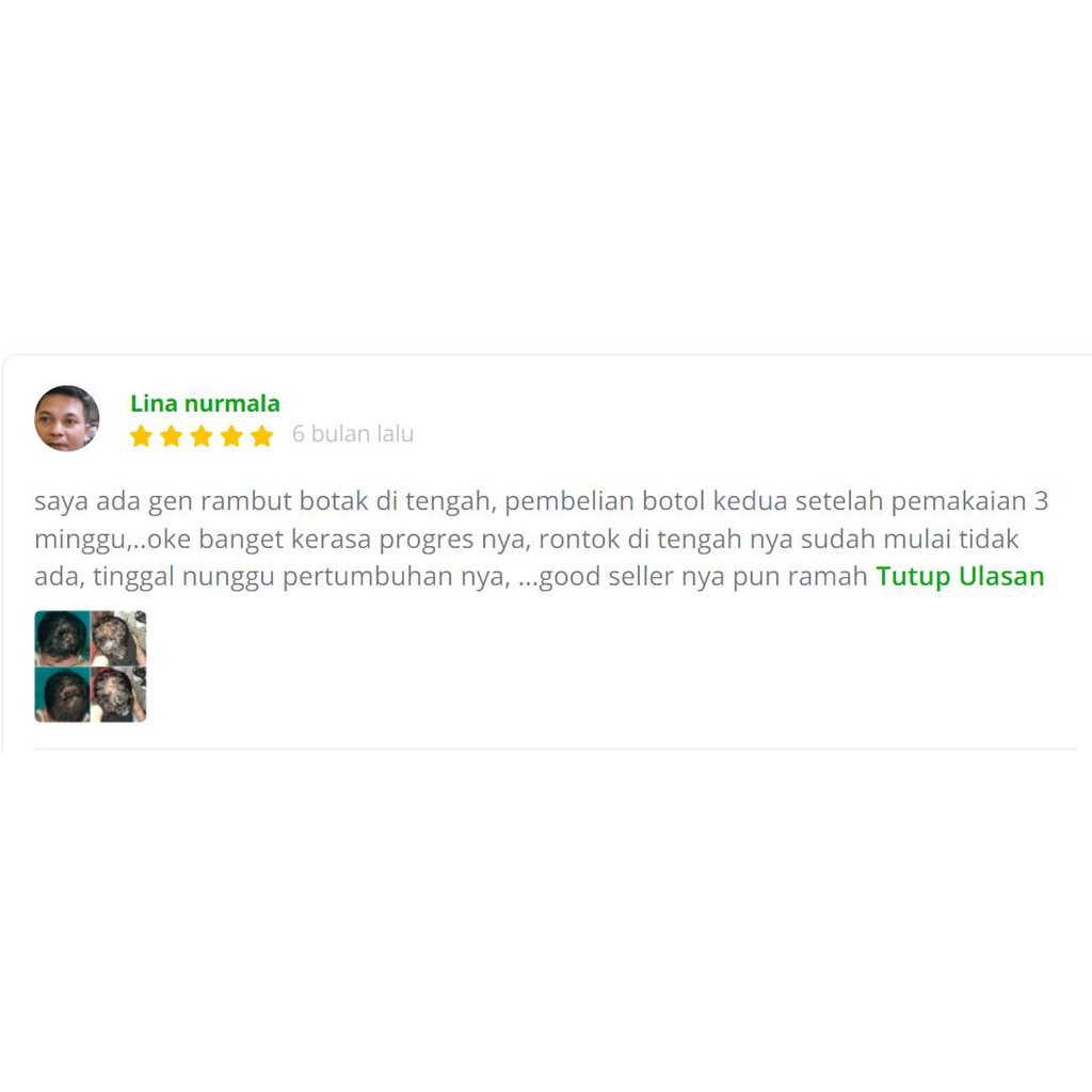 Happy Green Custom Oil buat Kesehatan Rambut Faktor Keturunan - Genetic Hair Loss