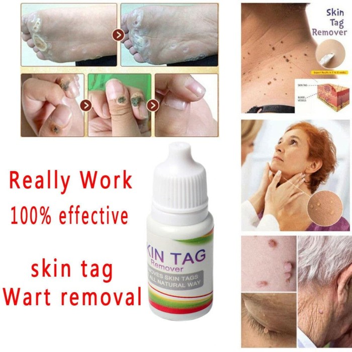 

Obat Kesehatan Penghapus Kutil Muka - Kaki Dan Badan - Promo