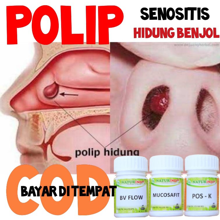 Bisa Cod Paket Obat Herbal polip Solusi Alami Pengobatan Sinusitis naturindo