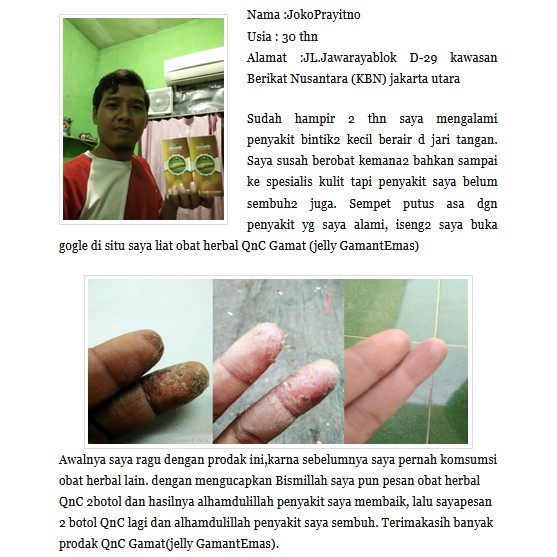 Obat Dermatitis Kontak Bintik Air Di Jari Tangan Kaki Gatal Gatal Kutu Air Herbal Qnc Jelly Gamat Shopee Indonesia