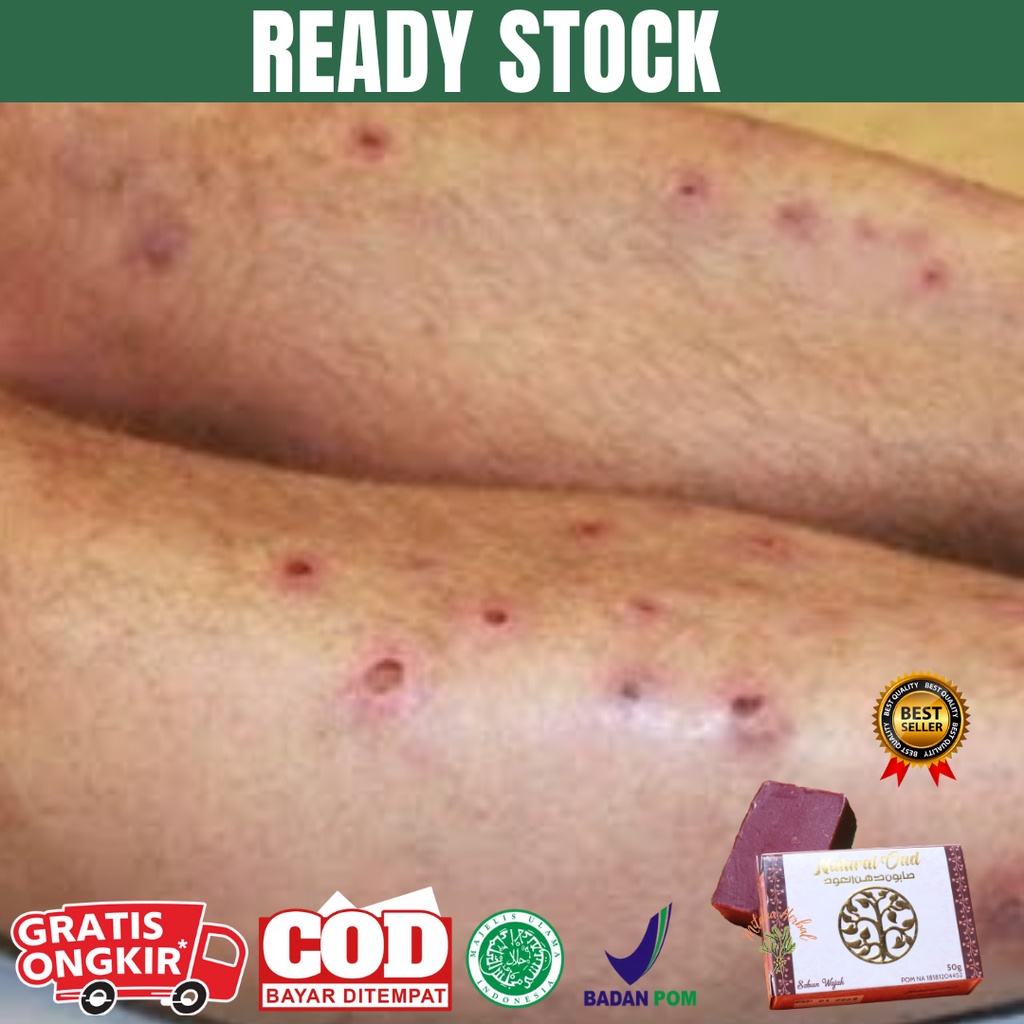 MIAL Obat Penghilang Bekas Cacar Air/ Penghilang Bekas Luka Hitam Yang Sudah Lama/ Penghilang Bekas 