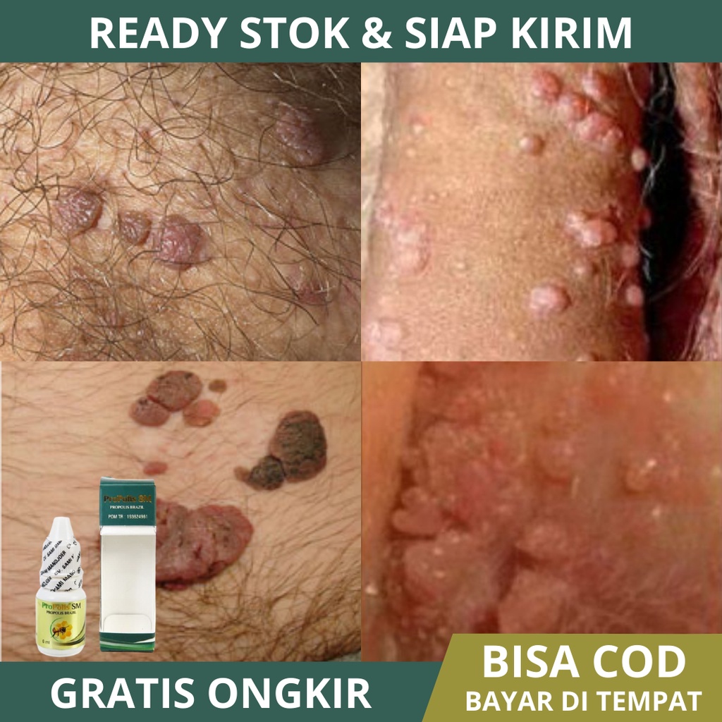 Obat Oles Perontok Kutil Kelamin, Kutil Kelamin Pria, Kutil Kelamin Wanita, Salep Kutil Kelamin, Pen