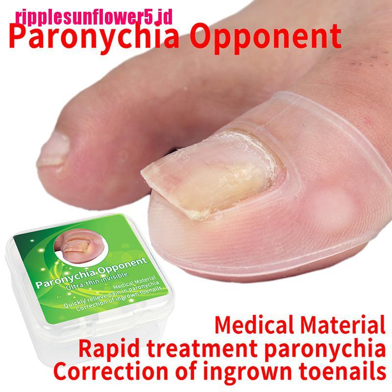 Korektor Kuku Kaki Tumbuh Ke Dalam Bahan Silikon