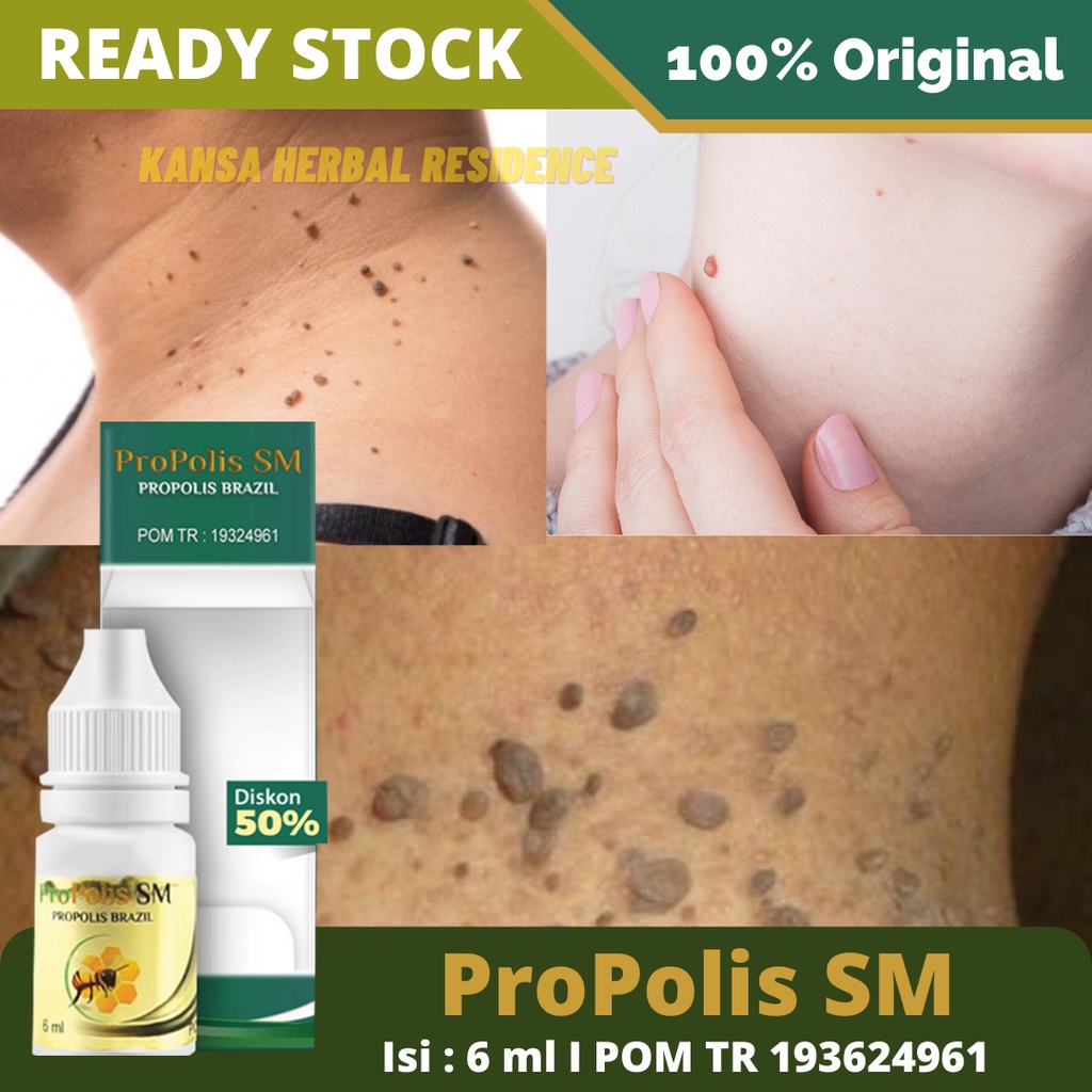 Obat Merontokan Kutil, Badan Kutilan, Kutil Di Leher - Badan - Tangan - Wajah - Punggung - Kaki, Kutil Kelamin, Obat Mengempiskan Daging Jadi, Obat Perontok Papiloma, Perontok Skin Tag, Obat Keloid Dengan Propolis SM 100% ORIGINAL ASLI