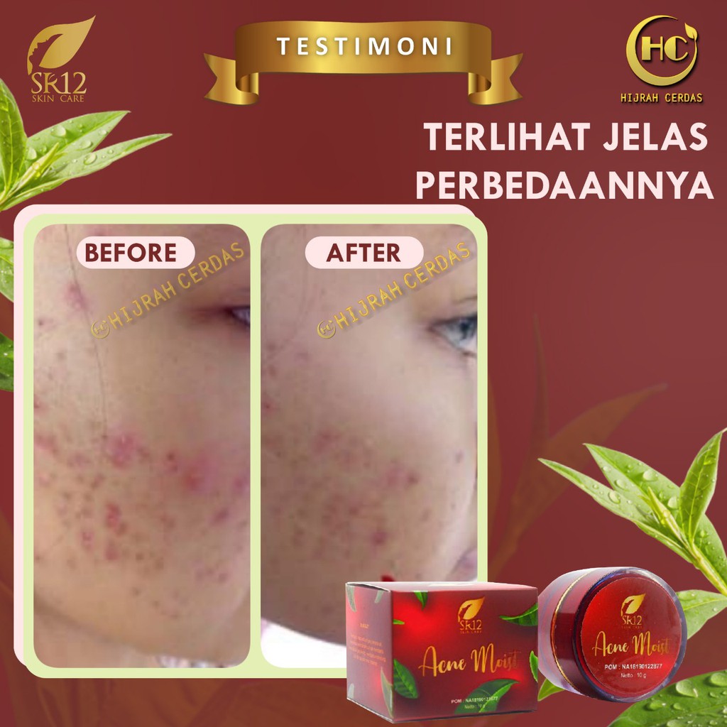 ACNE MOIST SR12 / CREAM UNTUK JERAWAT