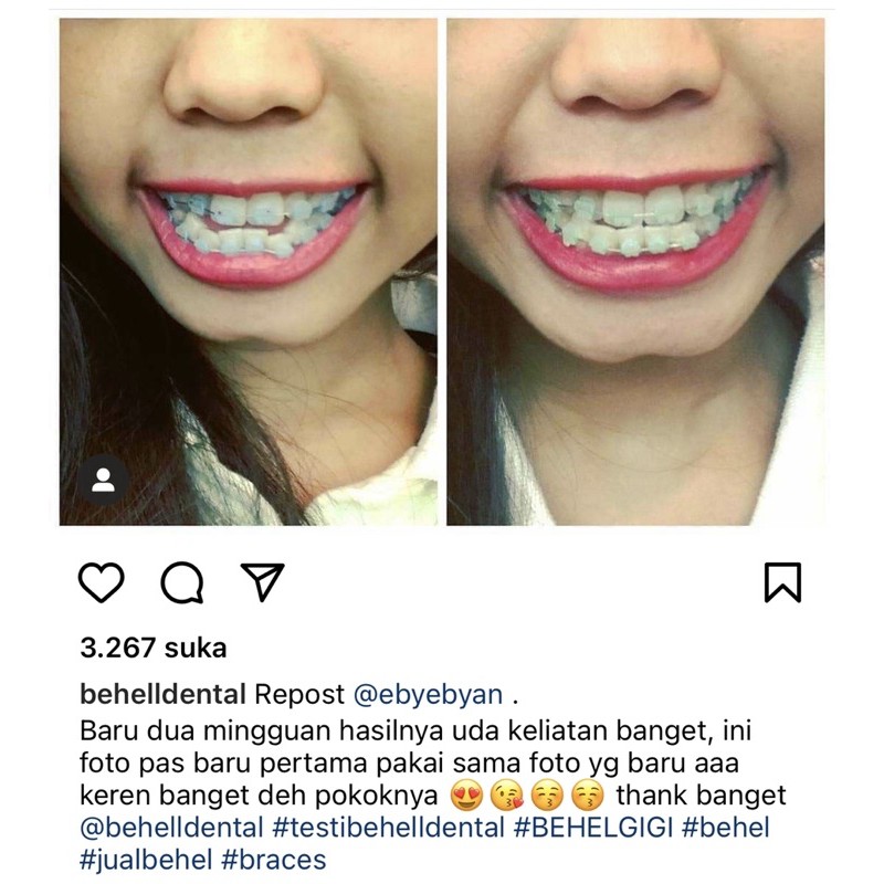 [ORIGINAL] BRACKET BEHEL PERMANEN CERAMIC CLASSONE USA // KERAMIK TRANSPARAN TRANSFARAN CLEAR DENTAL