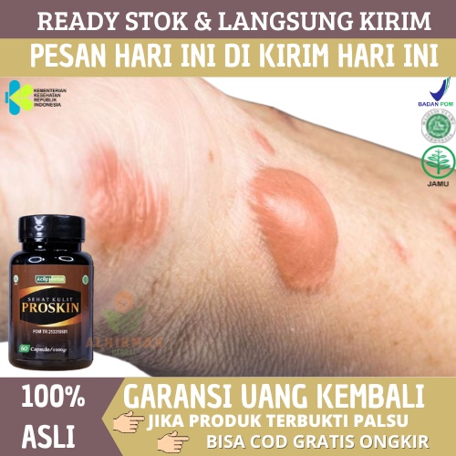 Obat Luka Bakar, Obat Luka Bakar Melepuh, Obat Herbal Untuk Luka Bakar, Obat Luka Bakar Berair, Obat