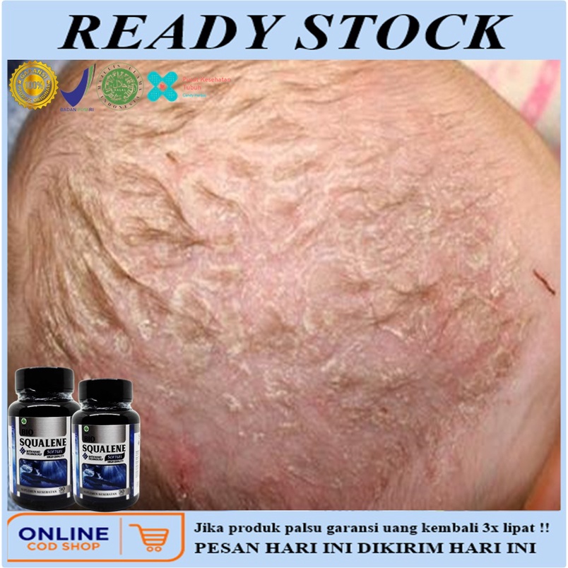 Obat Dermatitis Seboroik, Obat borok di kepala, obat dermatitis seboroik bayi, Obat dermatitis sebor