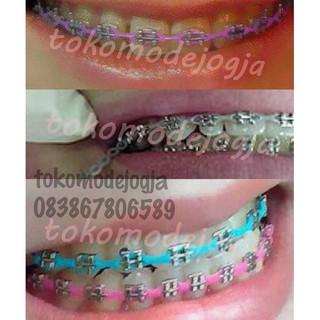 Behel Gigi Lepas Pasang Asli Original Sepasang Atas Behel Gigi Lepas Pasang Asli Original Sepasang Atas