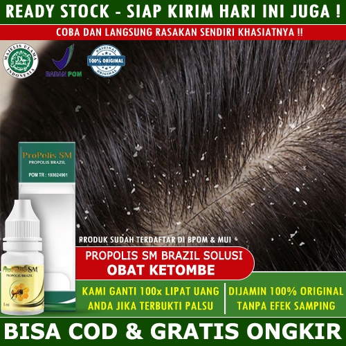 Obat Ketombe Parah Berkerak Bersisik Tetes Penghilang Ketombe Membandel Psoriasis Kulit Kepala Borok