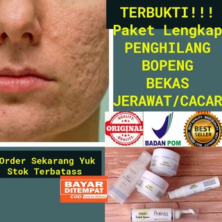 Paket Cream Penghilang Bopeng Pratista Atau Obat Lubang Bekas Jerawat Pratista Shopee Indonesia