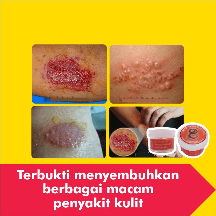 Salep Obat Gatal Eksim Kering Menahun Paling Ampuh Kulit Gatel Exim Basah Saleb Selangkangan Kurap Kutu Air Luka Diabetes Panu Kudis Kadas-5