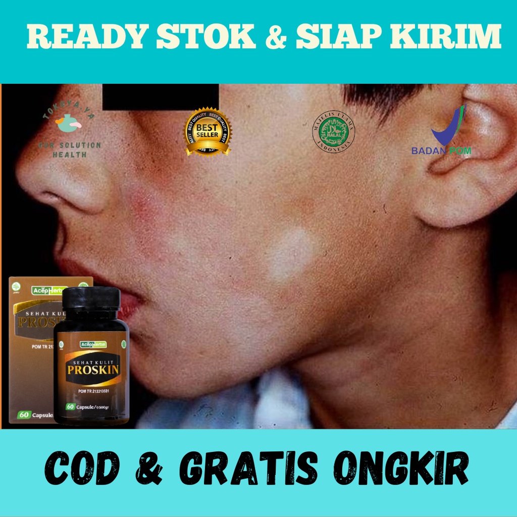 PROSKIN, Obat Penghilang Panu / Hapur Menahun, Obat Menghilangkan Panu, Obat Ngilangin Balas Bogo, O