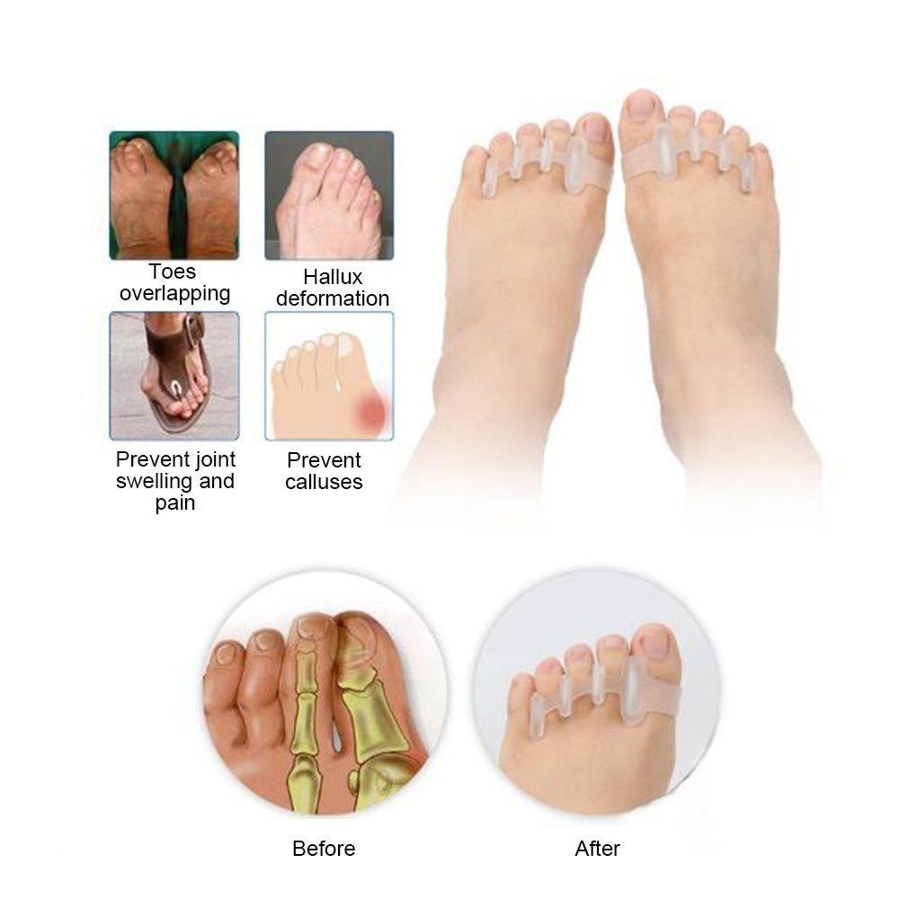 Nanas 1pasang Silikon Pemisah Jari Kaki Unisex Perawatan Kesehatan Align Toes Valgus Foot Care Tools