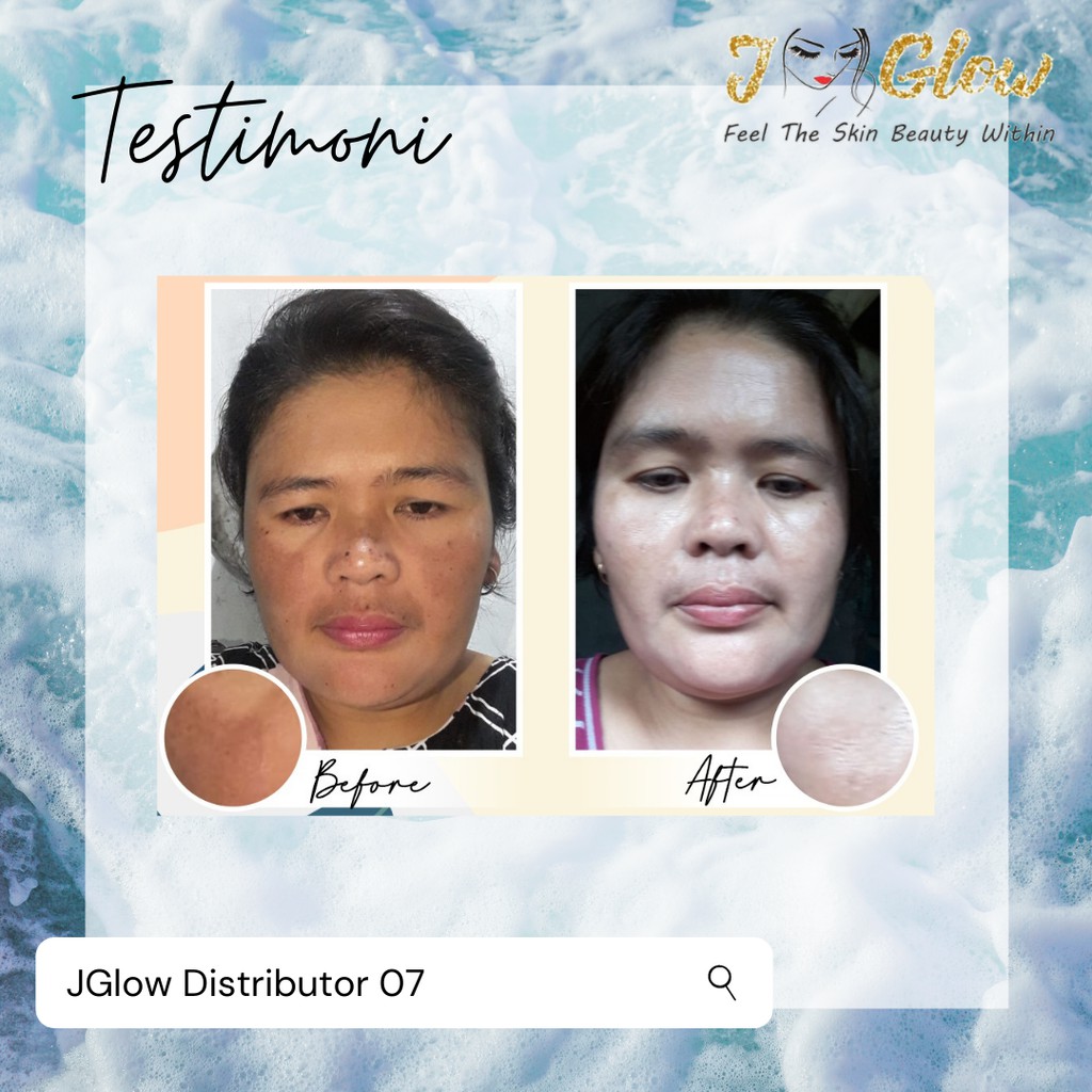 JGLOW Flek Melasma Hyperpigmentasi | Paket Perawatan Wajah Skincare BPOM-5