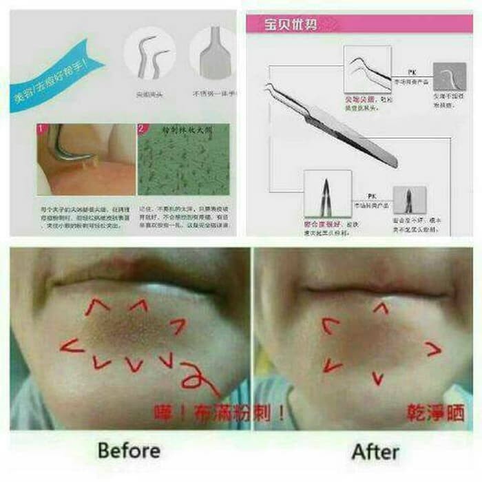 Pinset Jepit Komedo  Blackhead Tweezer penjepit jerawat acne skin cares kecantikan make up