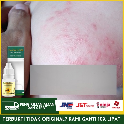 Obat Penghilang Gatal Dipantat - Menghilangkan Bentol Di Bokong - Jerawat Bokong - PROPOLIS SM
