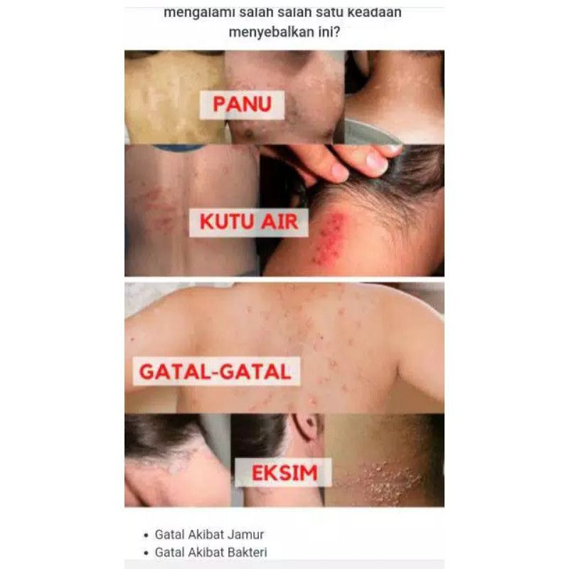SALEB BL ORIGINAL ASLI 100% / OBAT GATAL SELANGKANGAN PALING AMPUH / SALEP GATEL SELANGKANGAN PANU KADAS KUTU AIR-8