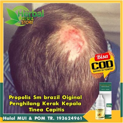 Propolis Sm brazil Original Penghilang Kerak Kepala / Tinea Capitis - Salep Herbal Gatal gatel Tinea
