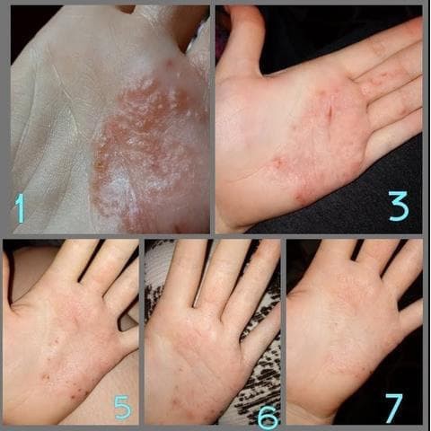 Sabun Herbal ZUDAIFU obat eksim Psoriasis jerawat jamur