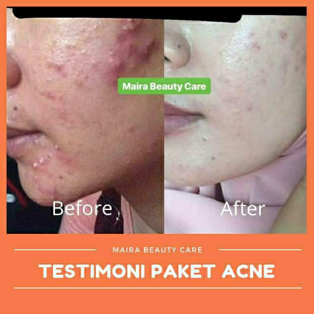 ACNE BRIGHT DOUBLE ACTION SERIES-1