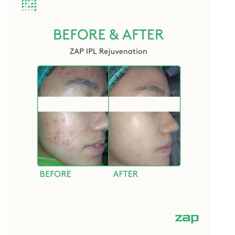 Serbuuuu.. [Khusus ZAP Clinic Paskal Bandung Opening] 2x IPL Rejuvenation