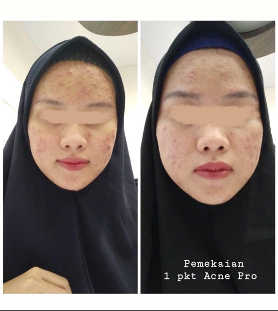 Cream Wajah Glowing BPOM Paket Premium Acne Pro by Suastikana Skincare Indonesia Untuk Jerawat-3