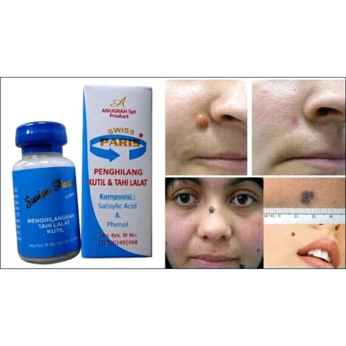 Penghilang Tahi Lalat Asli | Obat Penghilang Tahi Lalat Dan Kutil Alami Tanpa Operasi Murah BPOM