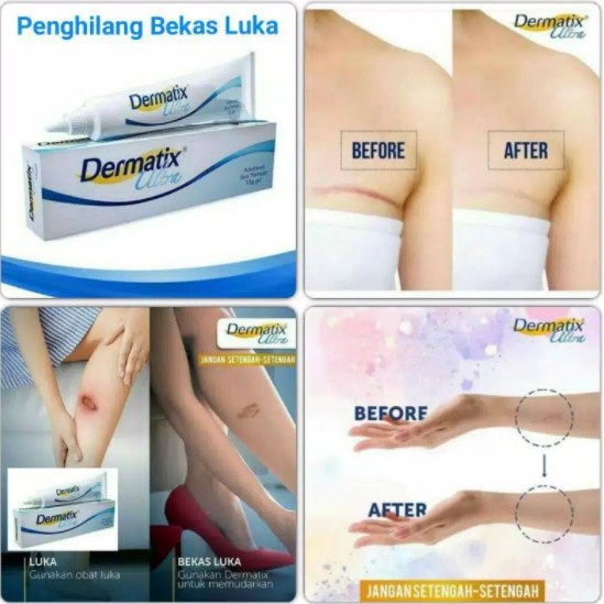 Dermatix Ultra Gel 15g Penghilang Bekas Luka / Keloid ANTI SCAR Stretchmark (49Pcs/1Box)