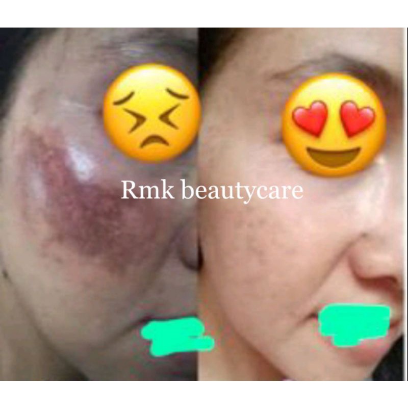 salep flek dosting / salep flek bandel / toner flek dosting / cream flek wajah susah putih / fleksol flek solution rmk