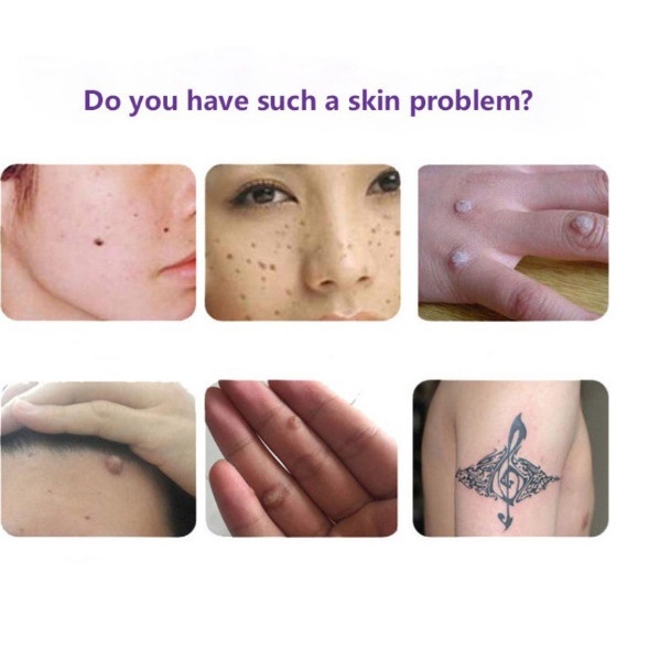 ORIGINAL | Skin Spot Cream Penghilang Kutil Bintik Bintik Gelap Kulit Tanpa Rasa Sakit
