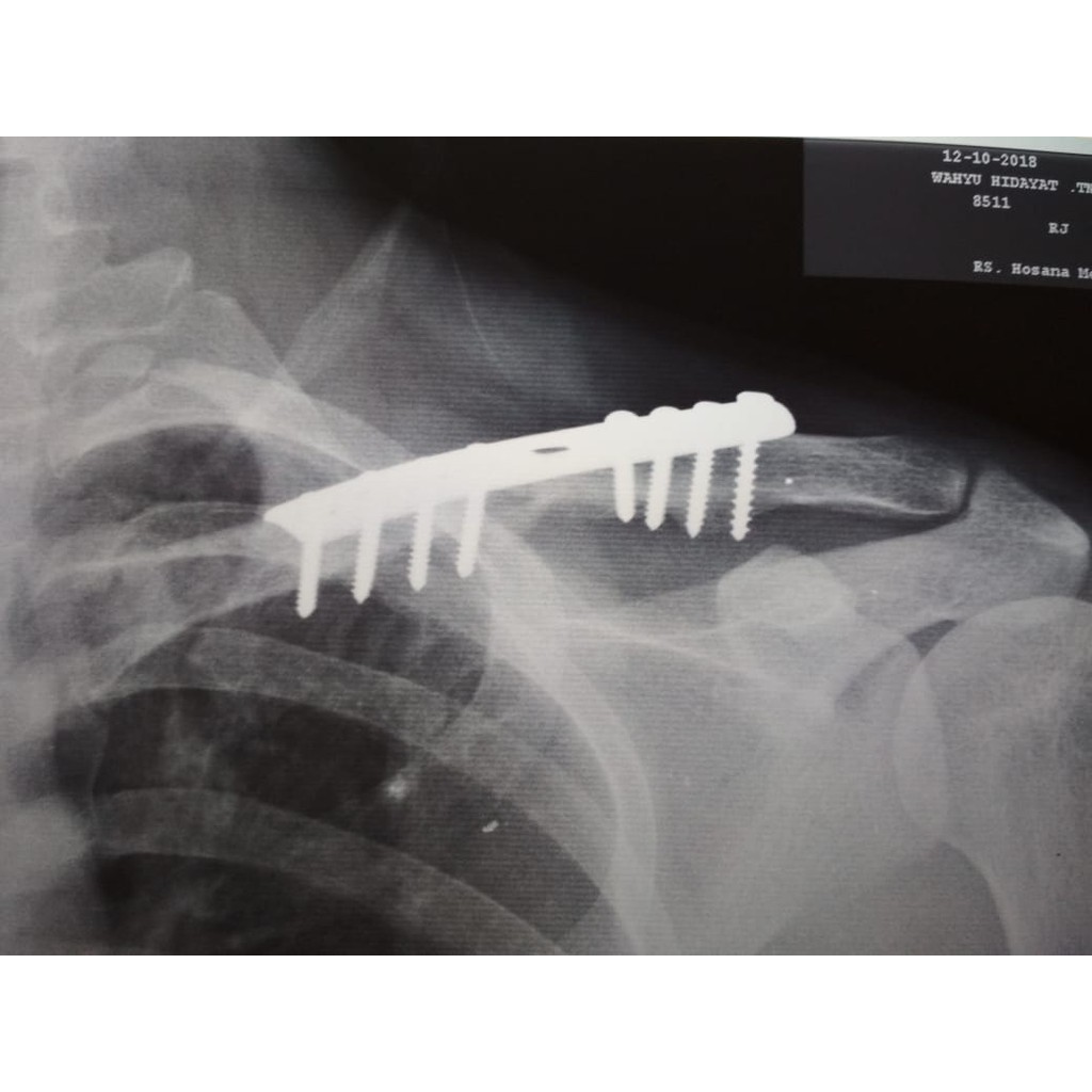 Pen Asli Platina Tulang Selangka Pen Clavicula Shopee Indonesia