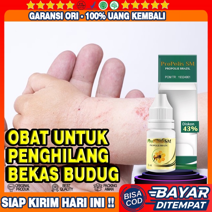 Obat Penghilang Bekas Budug, Obat Budug Parah, Obat Koreng Menahun, Obat Penghilang Koreng Alami