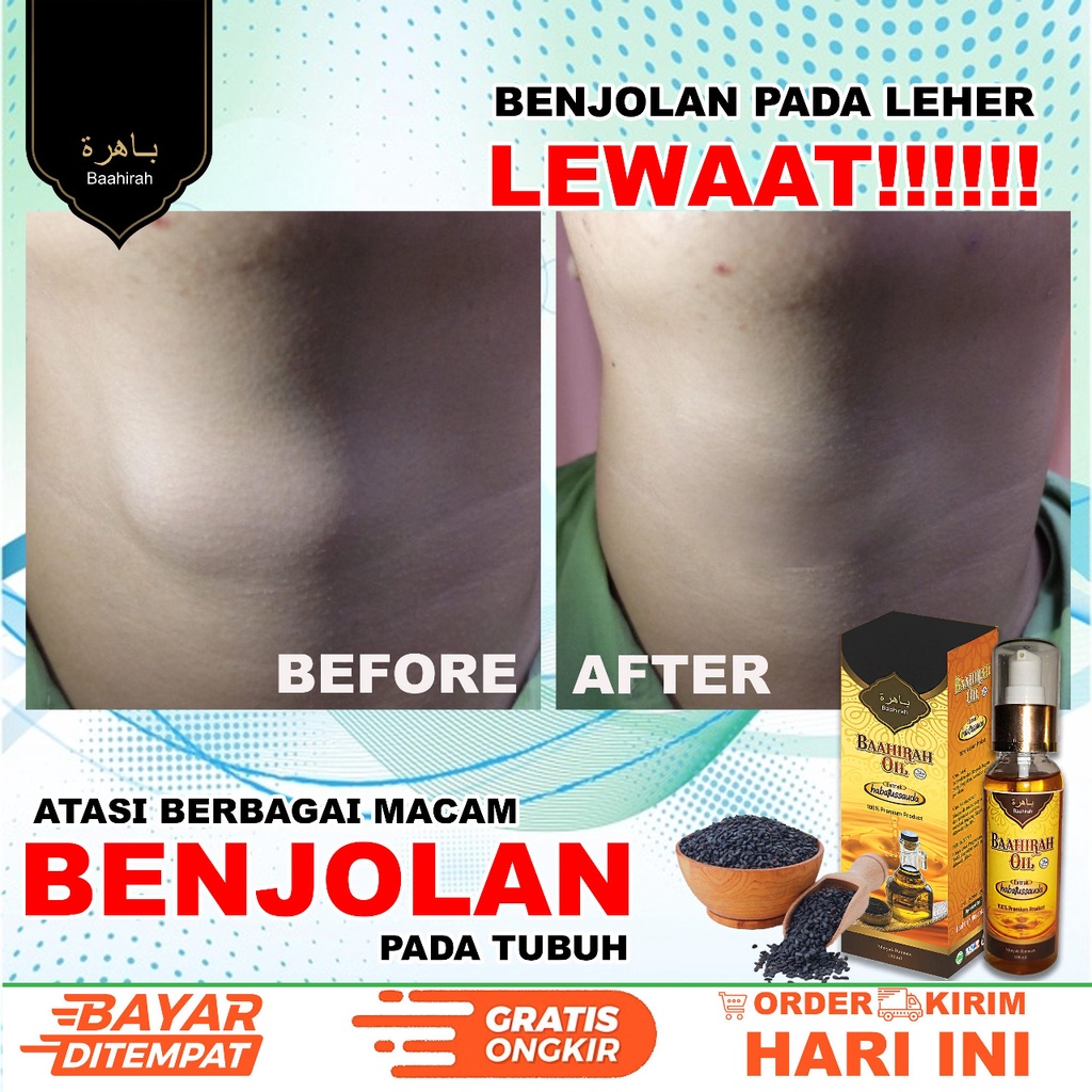 [MINYAK OLES BAAHIRAH OIL]- BENJOLAN GONDOK - OBAT BENJOLAN LIPOMA - KANKER - UCI UCI -