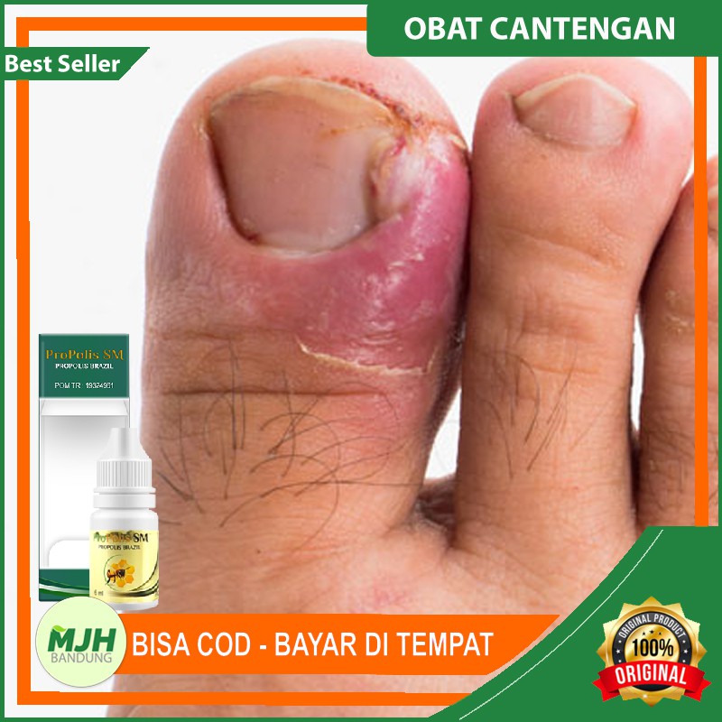 Obat Cantengan Parah - Cantengan Kuku Jari Tangan dan Kaki - Cantengan Jempol Kaki