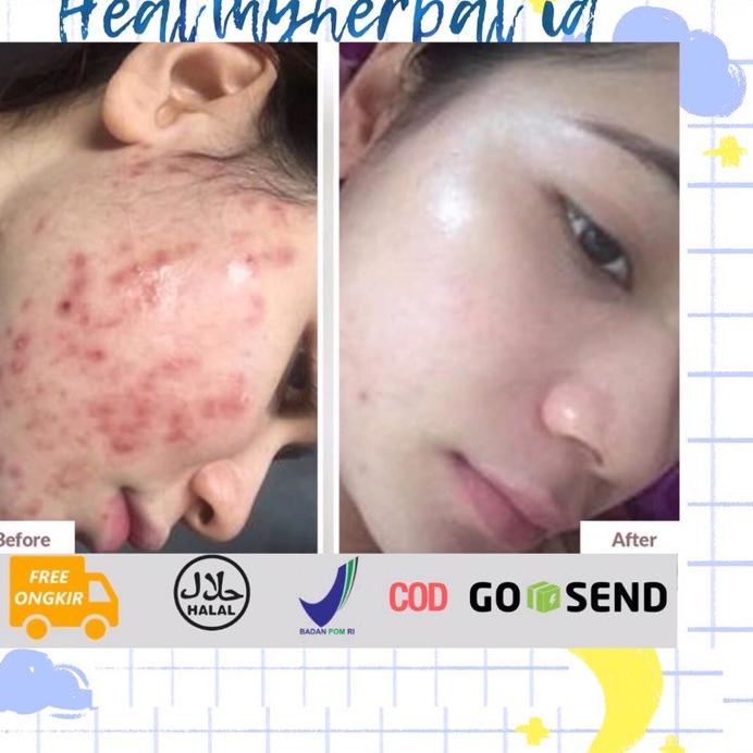 Event [7.7] CHITA OIL DIOLES 3X 7 HARI LNGSNG HILANG PERMANENT SEMUA GATAL , KORENG , KELOID, HILANG