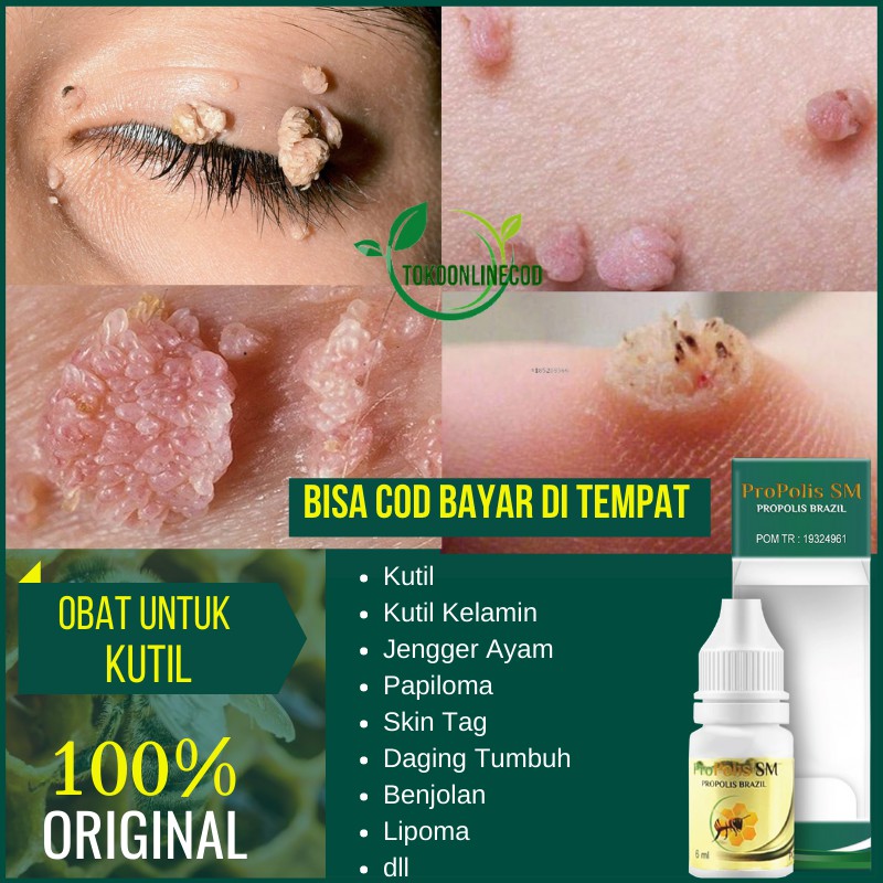 Obat Kutil Alami - Kutil Kelamin - Kutil di Wajah - Kutil di Leher - Kutilan PROPOLIS SM - COD