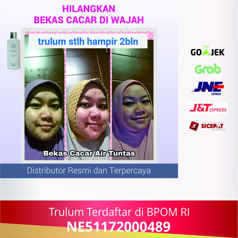 Trulum Atasi Noda Bekas Cacar dan Jerawat Membandel