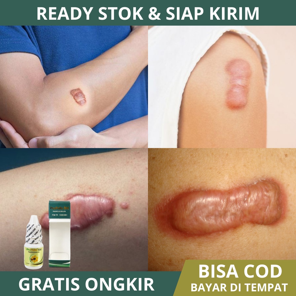 obat keloid - obat keloid daging tumbuh - Obat daging jadi - obat keloid menahun - obat penghilang k