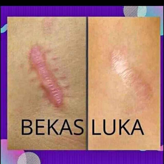 Penghilang keloid