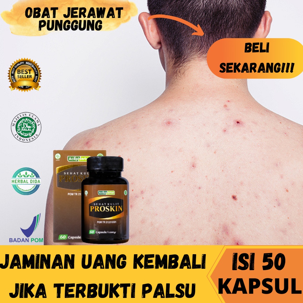 Obat Bekas Jerawat di Punggung, Obat Jerawat Punggung Membandel, Obat Jerawat di Punggung Dan Bekasn